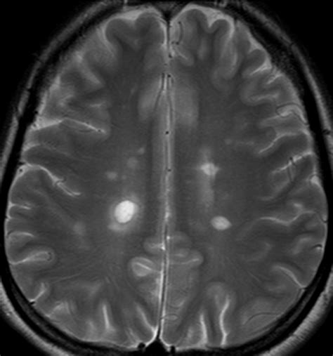 Ms Brain Mri With Contrast