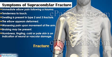 Supracondylar Fracture Classification Treatment Complications