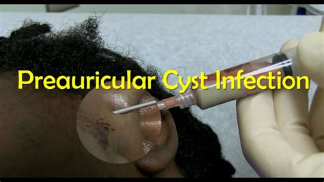 Preauricular Cyst Infection Management Youtube