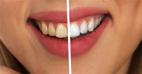 Gigi Kuning Ternyata Jauh Lebih Sehat Daripada Gigi Putih Cemerlang