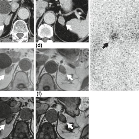 Imaging Study Of Bilateral Adrenal Masses Computed Tomography Scan