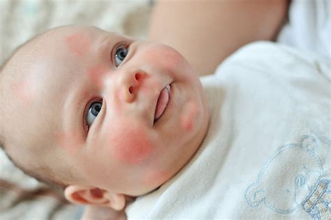 Milk allergy affects between 2% and 3% of babies and young children.813 to reduce risk, recommendations are that babies should be exclusively breastfed for at least four months, preferably six months, before introducing cow's milk. Milk allergy - Causes, Symptoms and Treatment | Health Care "Qsota" - Tips and Tricks Doctors