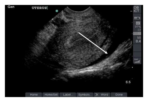 Pelvic Ultrasound Demonstrates The Same Hypoechoic Fluid Collection