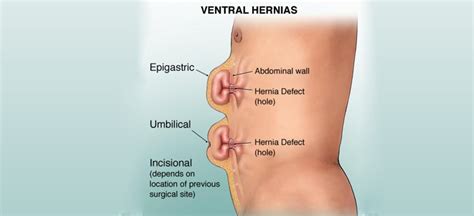 The hernia simulator was developed to demonstrate the basic intrumentation and progression of a. Signs and Symptoms of Hernia in your Child - Neoalta ...
