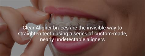 Bring Back Your Smile With Clear Aligner Braces Mayfield Dental