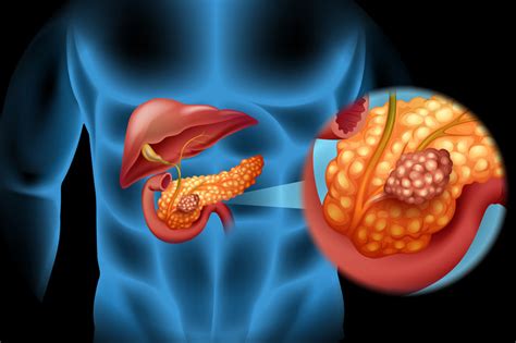 Here's the knowledge you need to beat the disease. Why Is Pancreatic Cancer So Hard to Treat? | Memorial ...