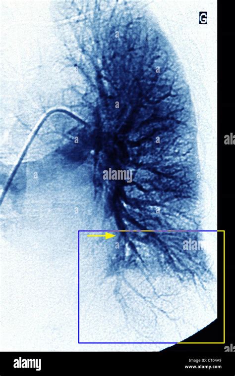 Infarto Pulmonar Angiografía Fotografía De Stock Alamy