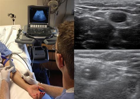 Ultrasound Guided Placement Of Peripherally Inserted Central Venous