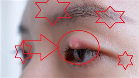 How To Get Rid Of A Chalazion On Eyelid Youtube