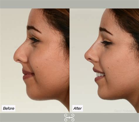 Non Surgical Nose Job Charleston Facial Plastic Surgery