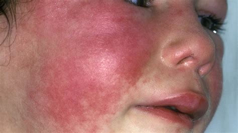 Scarlet Fever Highest Number Of Cases In 20 Years Bbc News