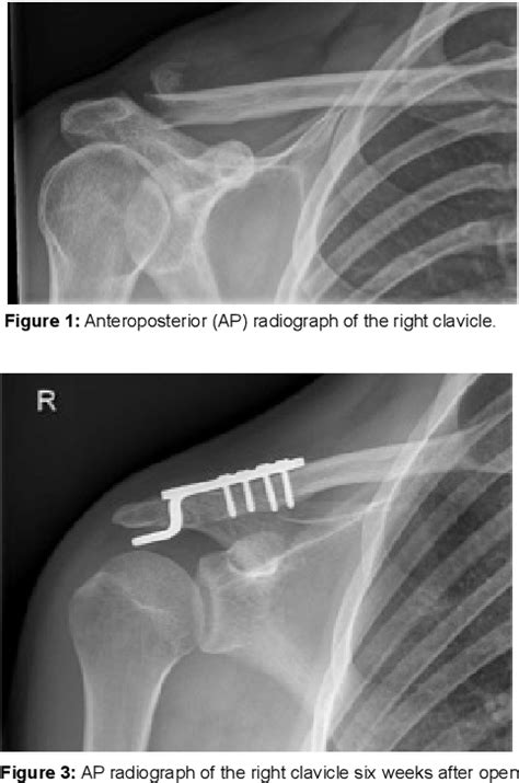 Figure 1 From A Distal Clavicle Fracture With Unusual Displacement Of