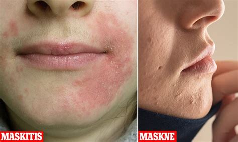 Are You Suffering From Maskitis Celebrity Skincare Expert On Painful