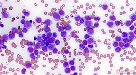 Aml M5 Acute Monoblastic Leukaemia Learnhaem Haematology Made Simple