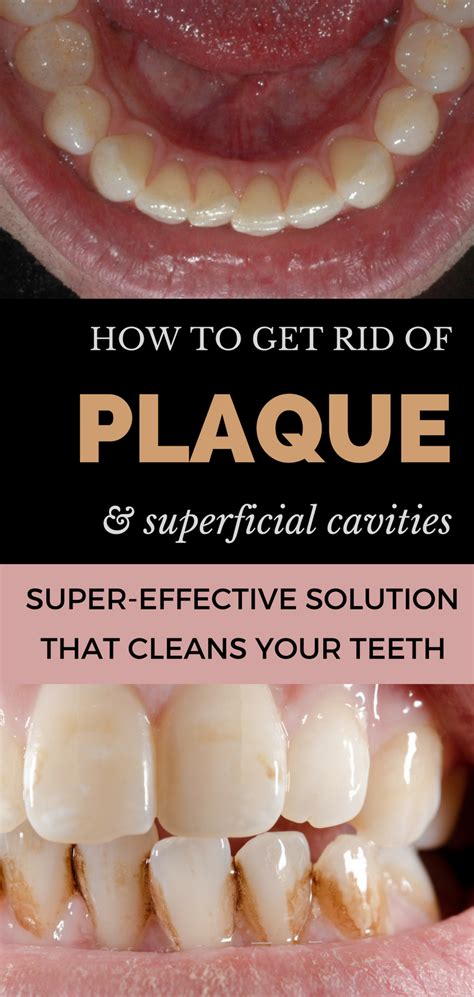How to use denture liners. How to Get Rid of Plaque and Superficial Cavities at Home ...