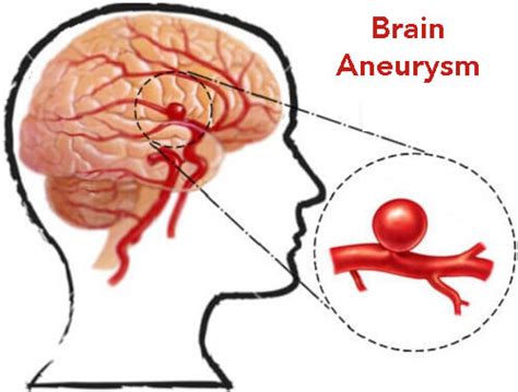Brain Aneurysm Causes Symptoms Diagnosis And Treatment Natural
