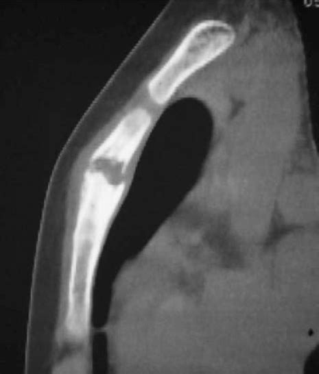 Computed Tomography Ct Showed An Osteolytic Lesion Th Open I