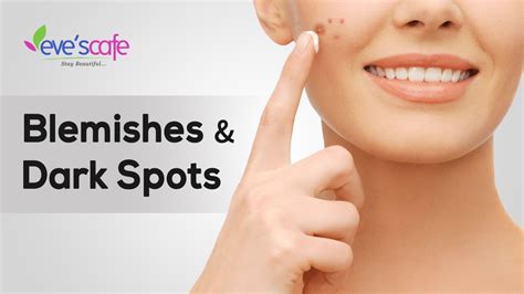 Home Remedies For Blemishes And Dark Spots Normal Skin Youtube