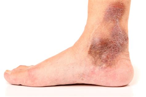 What Your Ankles Say About Your Health