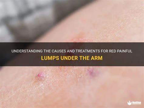 Understanding The Causes And Treatments For Red Painful Lumps Under The
