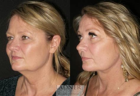 Facelift Neck Lift Before And After Pictures Case 31 Denver Co Ladner Facial Plastic Surgery