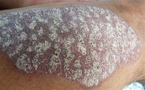 Severe Psoriasis Symptoms Pictures Symptoms And Pictures