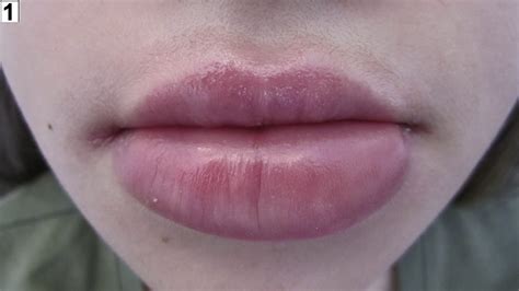 Causes Of Swollen Lips In The Morning