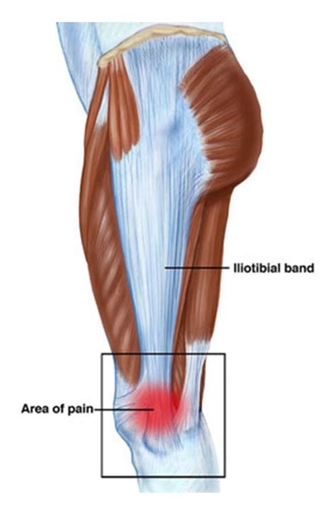 Knee Pain Itb Friction Syndrome Physio Brisbane