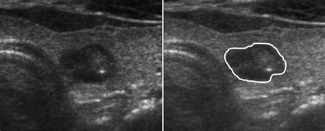 Computerized Analysis Of Calcification Of Thyroid Nodules As Visualized By Ultrasonography