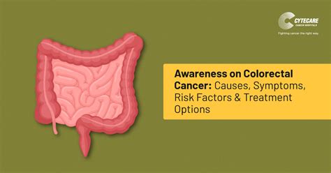 Colon Cancer Causes Symptoms Risk Factors And Treatment