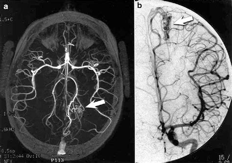 Comparison Of Mr Angiography And Conventional Angiography In The