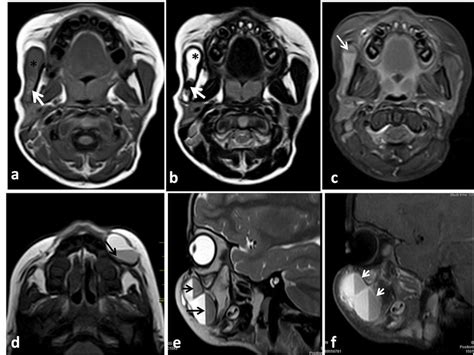 Mri Of Venous Malformation And Lymphatic Malformation Abc Mri Of 6