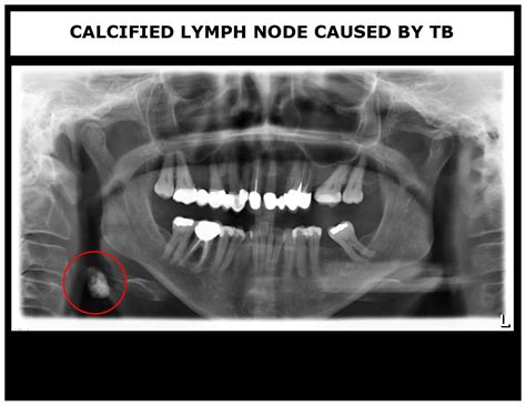 Calcified Lymph Nodes
