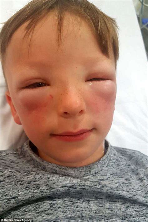Schoolboy 7 With Severe Hay Fever Saw His Face Treble In Size Take