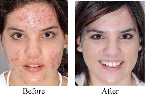 Acne Treatment At Best Price In Faridabad Id 6986951162