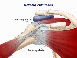 This connection enables the tendons to regulate forces between muscle tissues during movement so that the body remains stable. Bloomsbury Health Centre » Rotator Cuff Lesion SHOP03