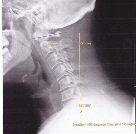 Case Of The Week Kyphotic Cervical Spine Joseph Ierano