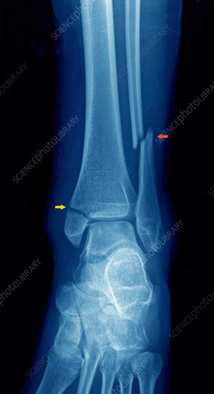 Broken Ankle X Ray Stock Image C0373092 Science Photo Library