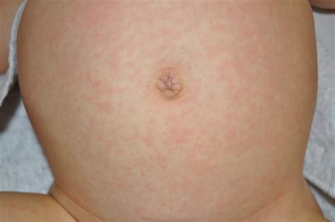 Roseola Rash Pictures Causes Symptoms Treatment Contagious