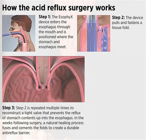 Incision Free Surgery Treats Acid Reflux Allegan Surgeon Is Training Other Doctors To Do The