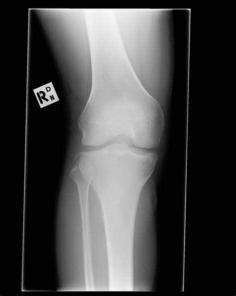 Segond fracture with anterior cruciate ligament and ...