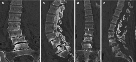 Anterior Column Support Options For Adult Lumbar Scoliosis