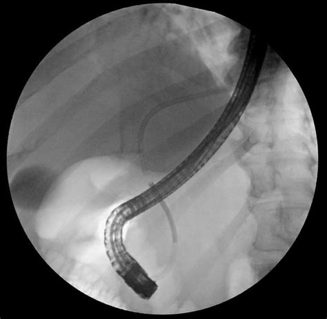 Ercp Image Showing Proximally Migrated Common Bile Duct Stent And