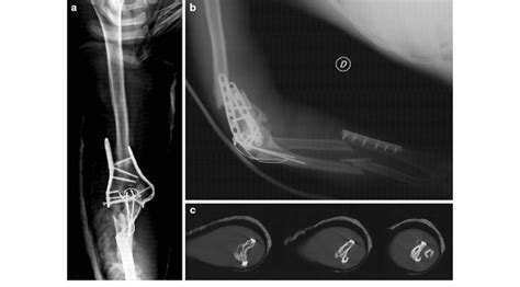 Ap A And Lateral B Radiographs At Hospital Admittance Show