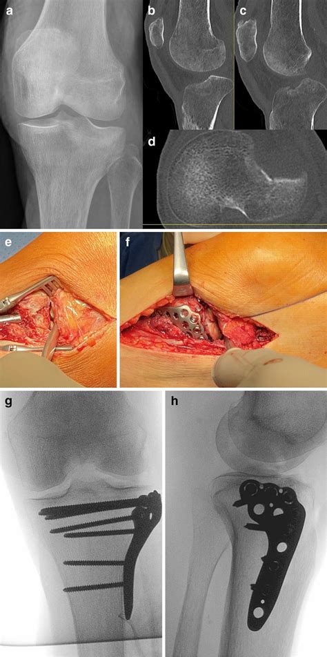 Lateral Tibial Plateau Fracture With Involvement Of Download