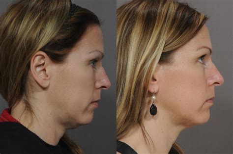 Ultherapy Before After Photo Gallery Rochester Victor NY Q