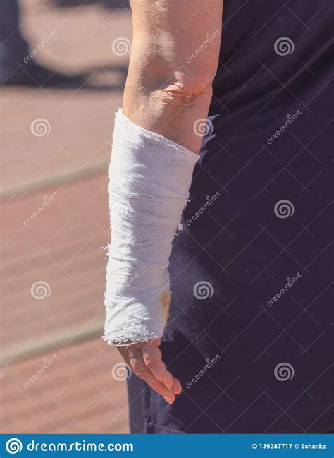 A Broken Arm In A Woman`s Cast Stock Image Image Of Person White
