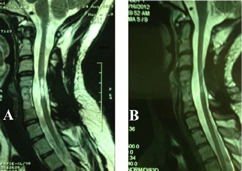 A Pre Operative T2 Weighted Mri Of A Patient With Cervical Spinal Cord