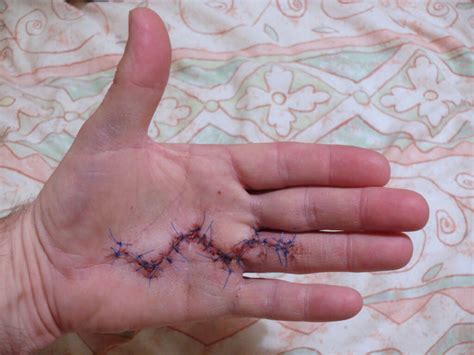 Dupuytrens Disease Manchester Hand And Wrist Surgery