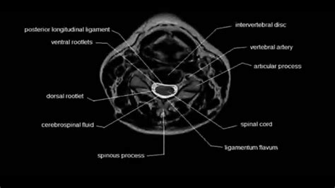 Mri Read Cervical Spine Axial View Anatomy Of Cervical Spine Axial View Youtube